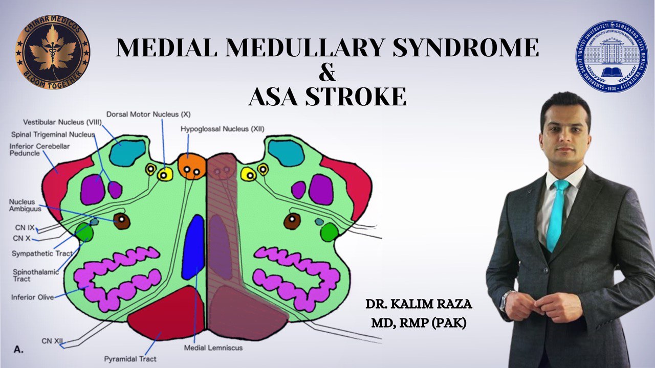 medial medullary syndrome and ASA stroke